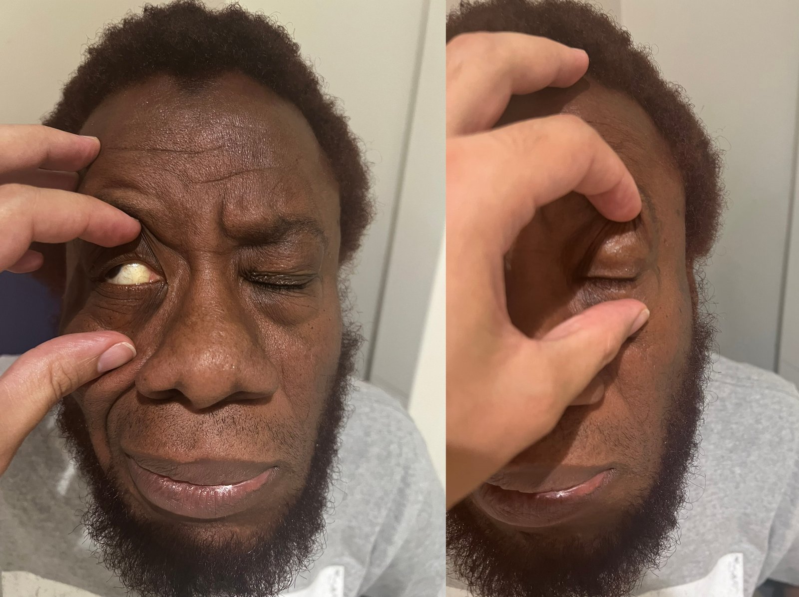 Eye Closure Weakness