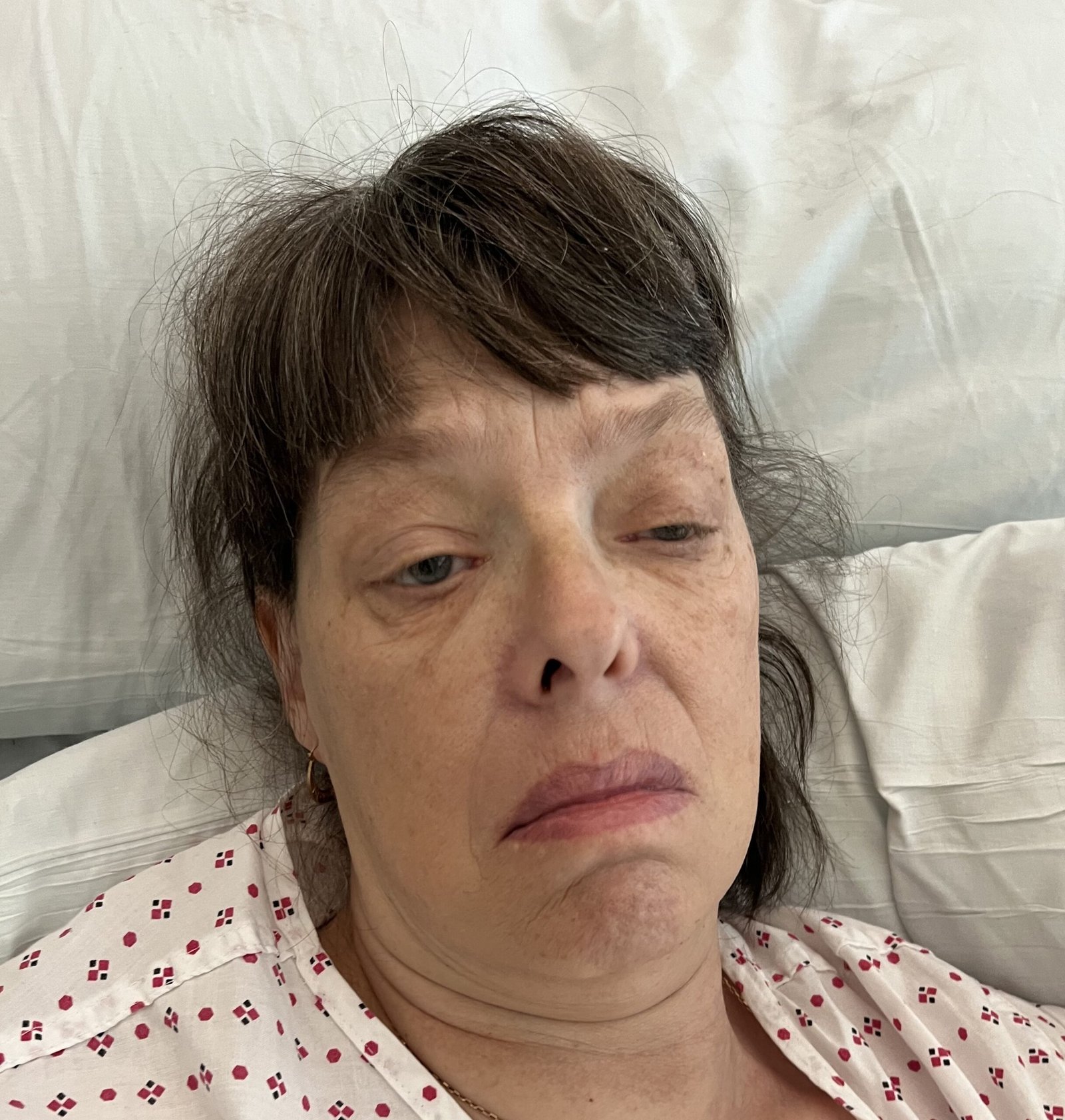 Myotonic Facies Ptosis Frontal Balding Masseter wasting Long thin face scaled
