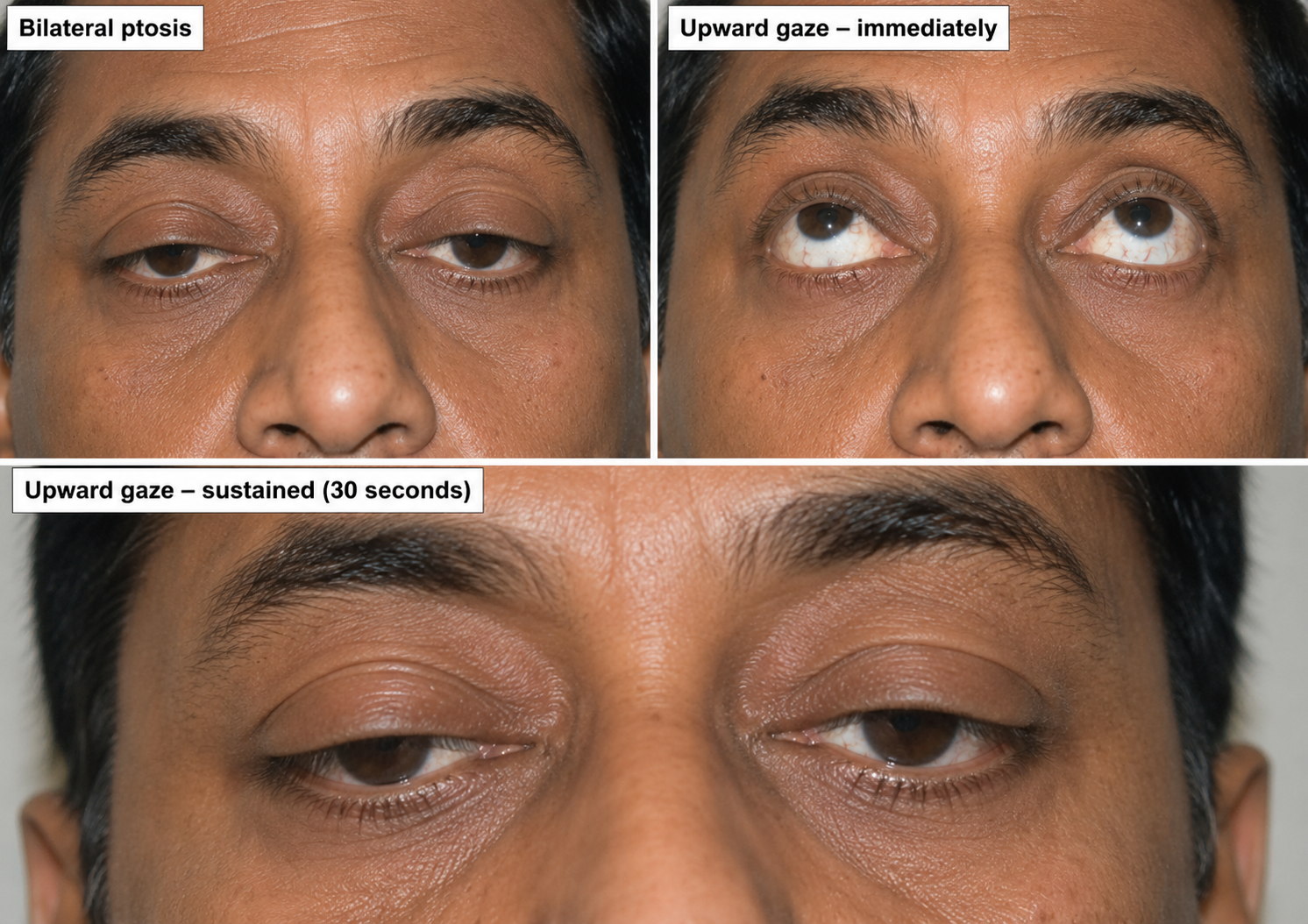 Myasthenia Gravis Ptosis Eye Signs