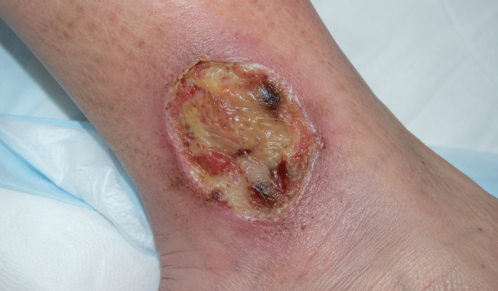 Pyoderma Gangrenosum Clinical Image