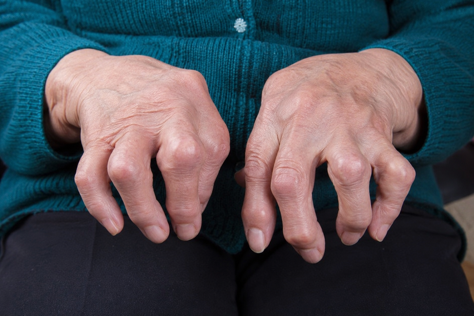 Rheumatoid hands clinical image