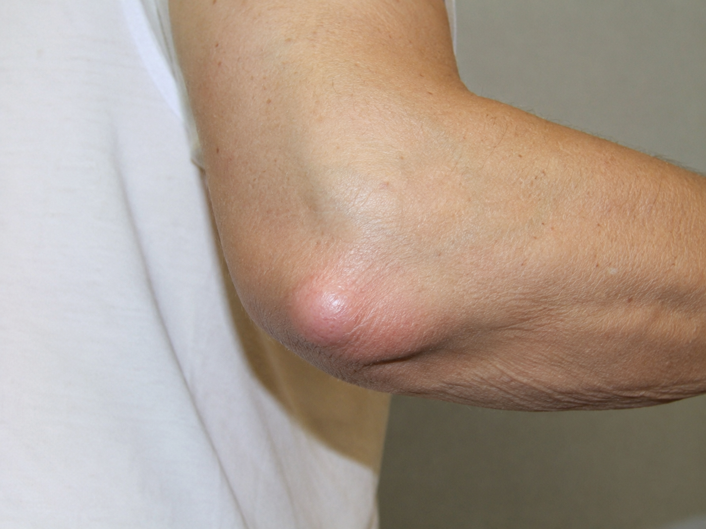 Rheumatoid nodule elbow